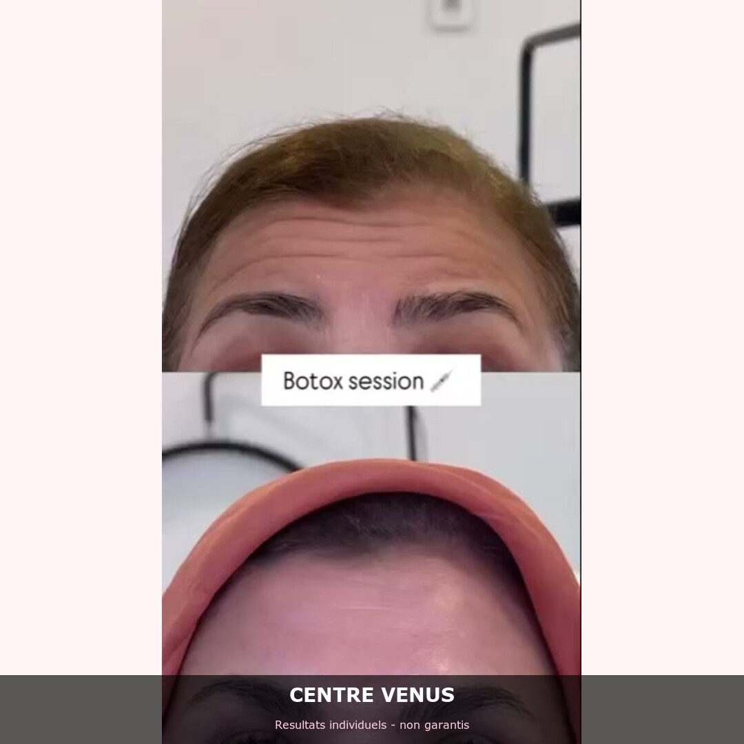 Botox Casablanca - avant apres - Centre Venus 1