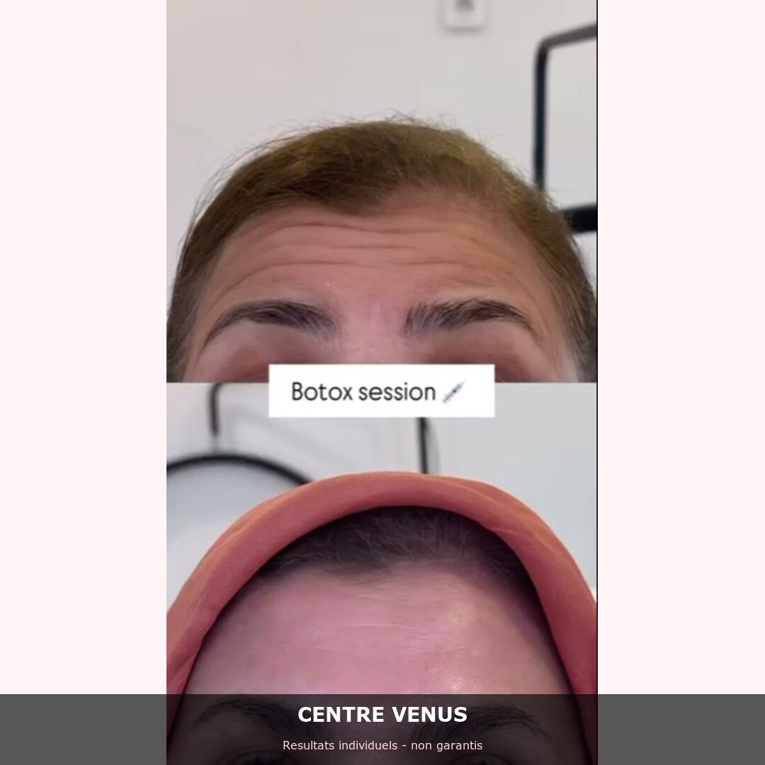 Botox Casablanca - avant apres - Centre Venus 3