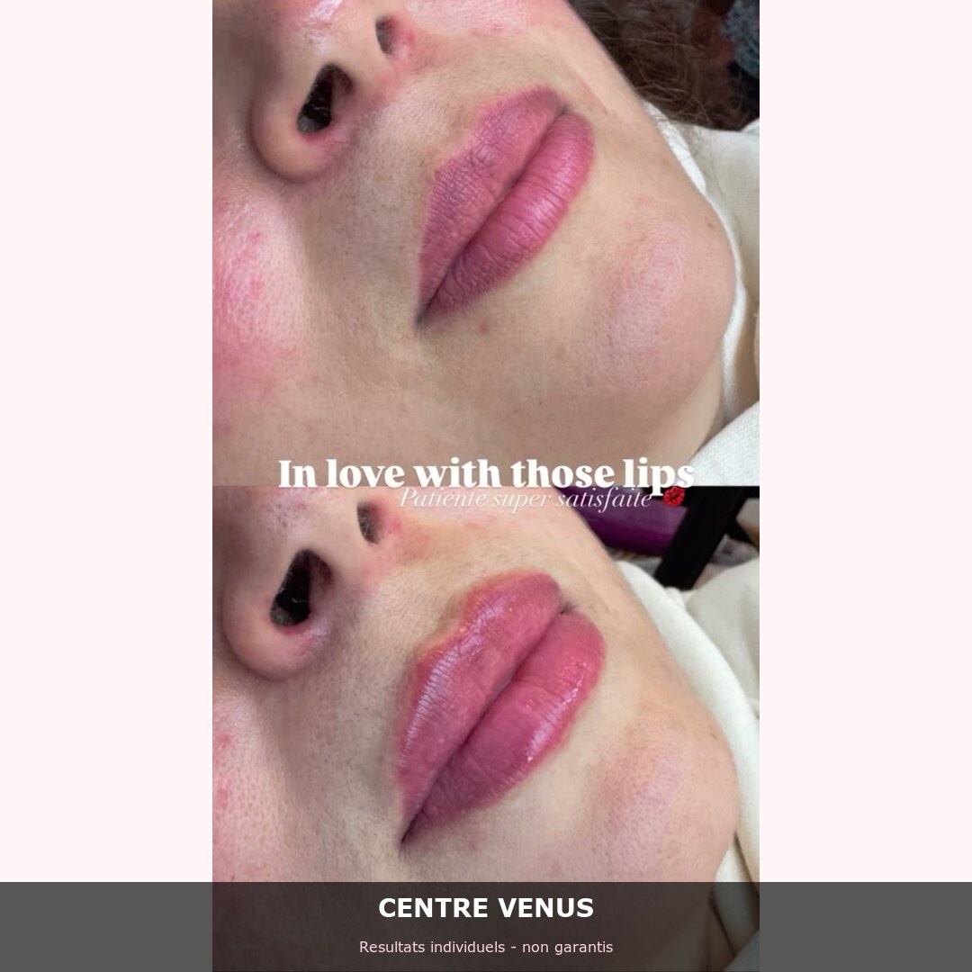 Fillers levres Casablanca - avant apres - Centre Venus 1