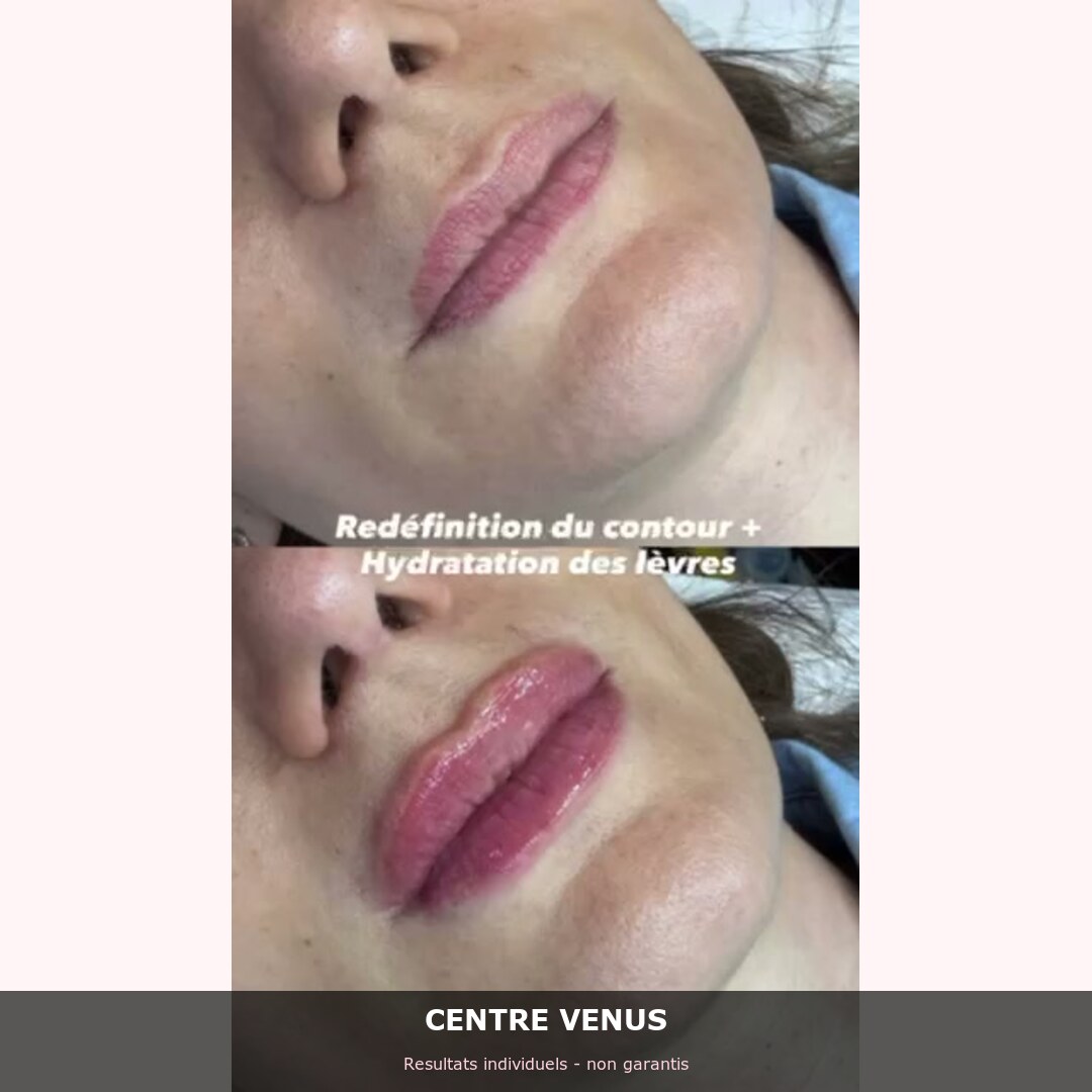 Fillers levres Casablanca - avant apres - Centre Venus 2