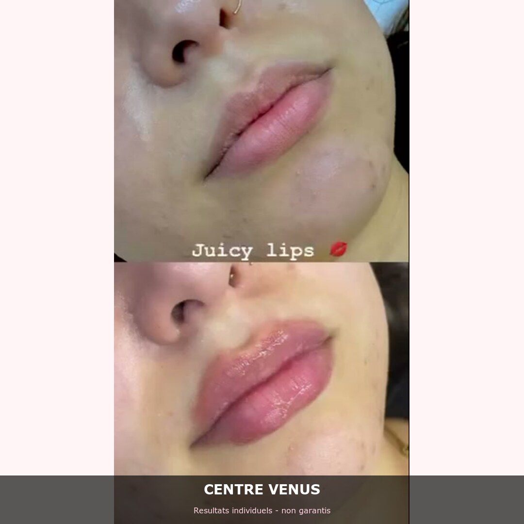 Fillers levres Casablanca - avant apres - Centre Venus 3