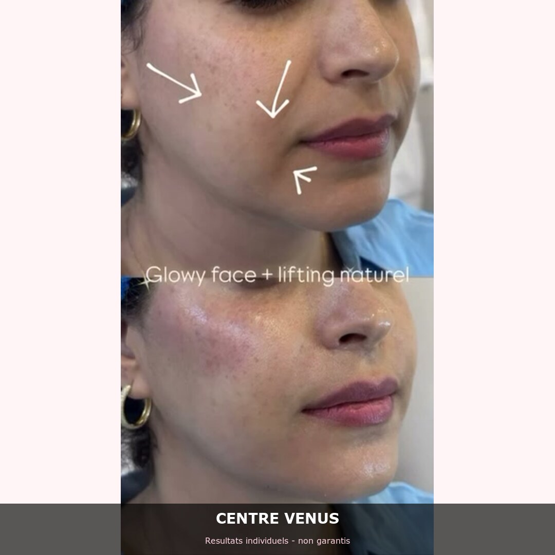 HIFU lifting Casablanca - avant apres - Centre Venus 2
