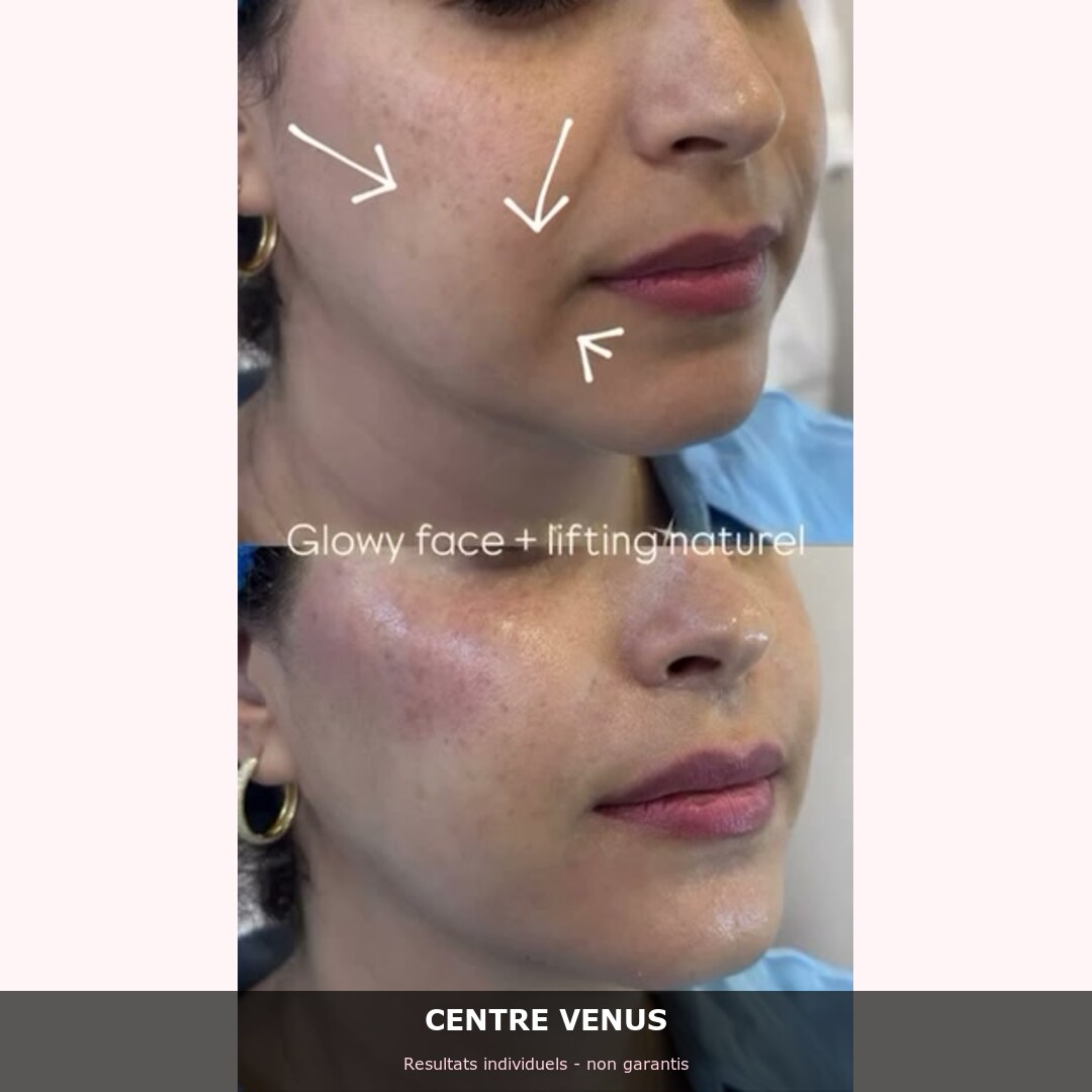 HIFU lifting Casablanca - avant apres - Centre Venus 3