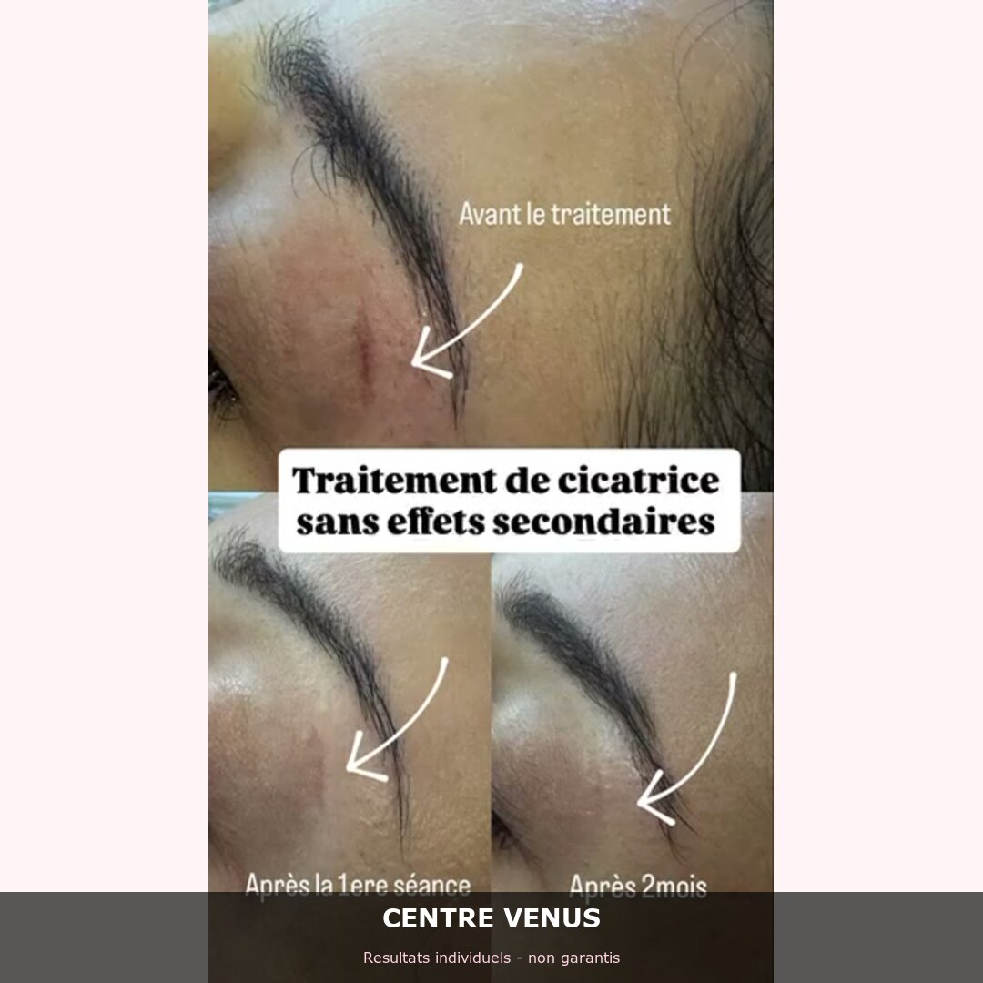 Radiofrequence fractionnee Casablanca - avant apres - Centre Venus 1