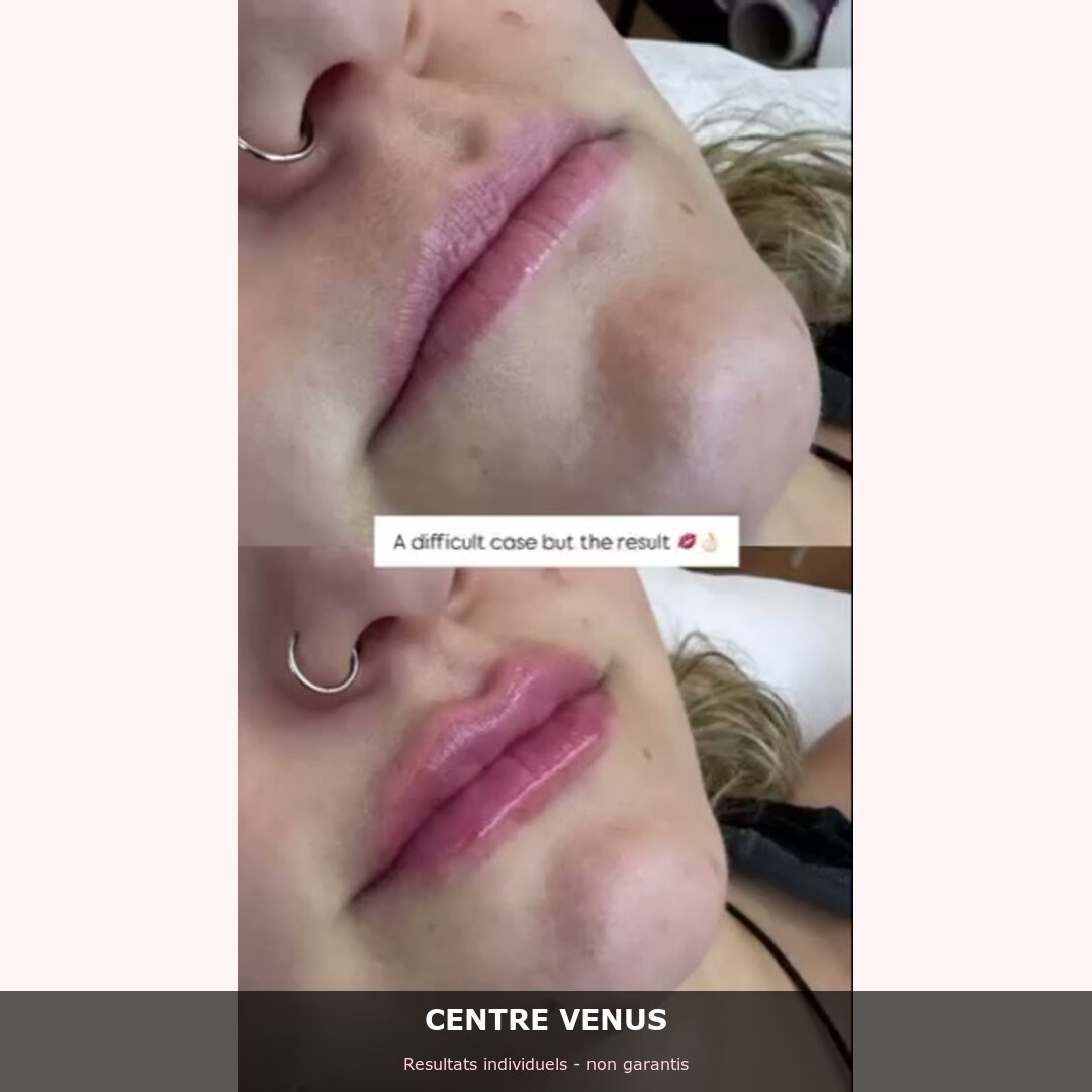 Radiofrequence fractionnee Casablanca - avant apres - Centre Venus 3