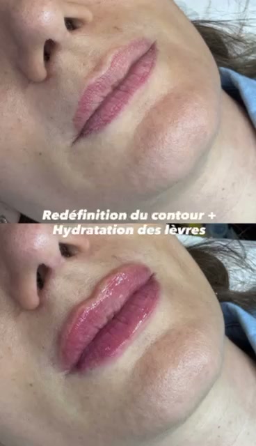 Avant apres redefinition du contour et hydratation des levres a Casablanca - Centre Venus Dr Najiba