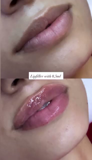 Avant apres lipfiller 0,5 ml levres a Casablanca - Centre Venus Dr Najiba