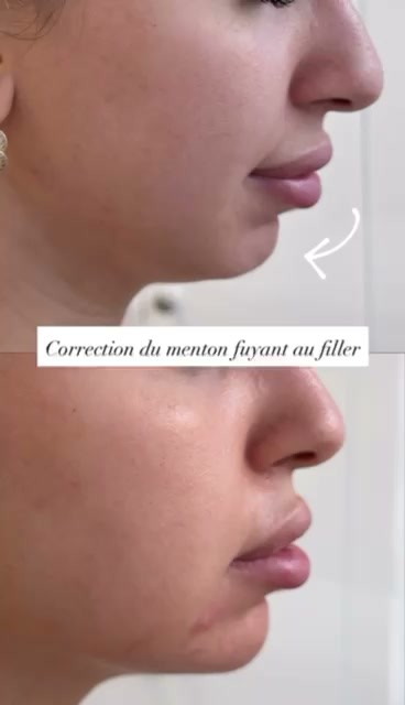 Avant apres correction menton fuyant au filler profil a Casablanca - Centre Venus Dr Najiba