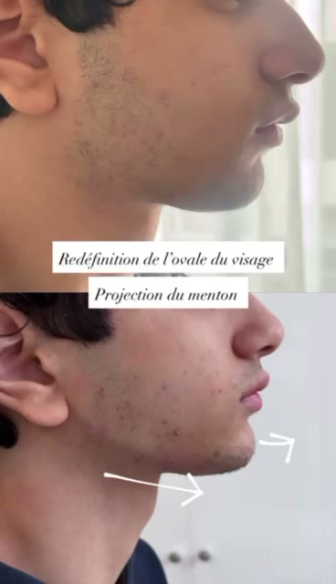 Avant apres redefinition ovale du visage et projection du menton a Casablanca - Centre Venus Dr Najiba