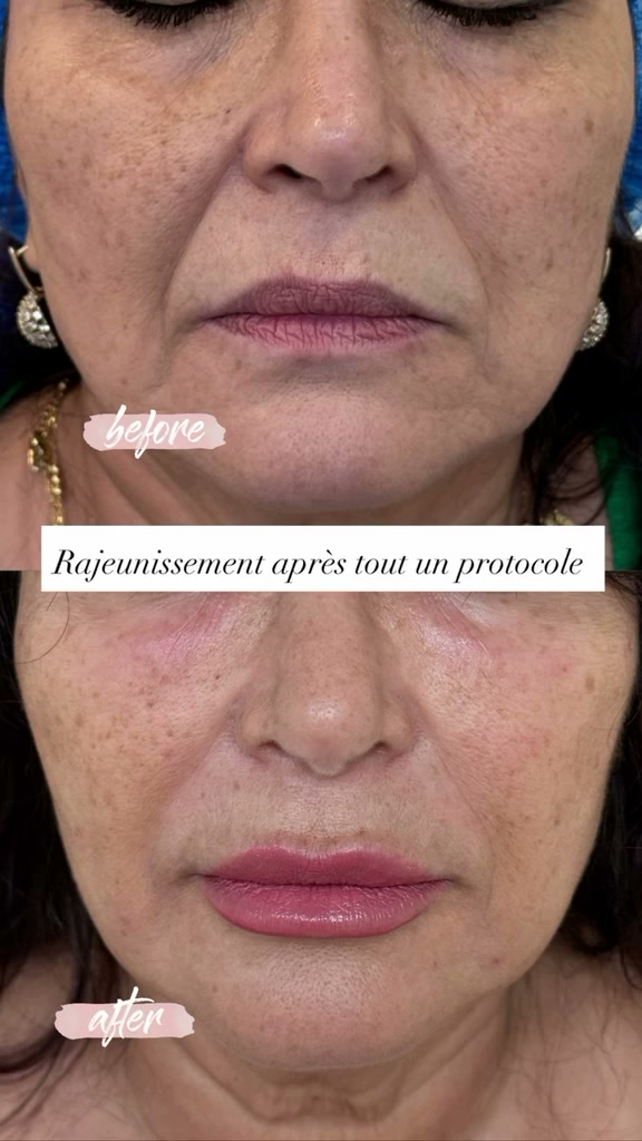 Avant apres rajeunissement du visage protocole complet a Casablanca - Centre Venus Dr Najiba